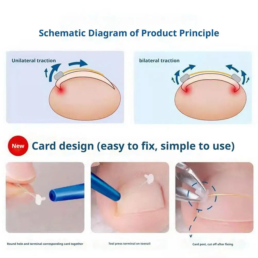 Titanium Alloy Toenail Corrector Orthopedic Sticker Memory Wire For Ingrown Nail Treatment Hallux Valgus Care Kit Ingrown Nail