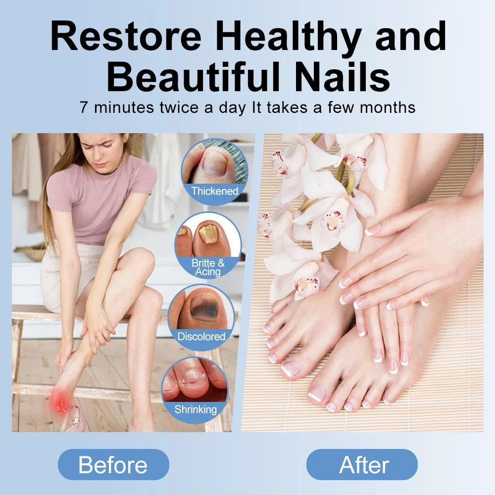 Nail Treatment Device for Fungal Infection,Nail Fungus Laser Assist Tool UV Professional Nail Fungus Blue Cleaning Laser Device