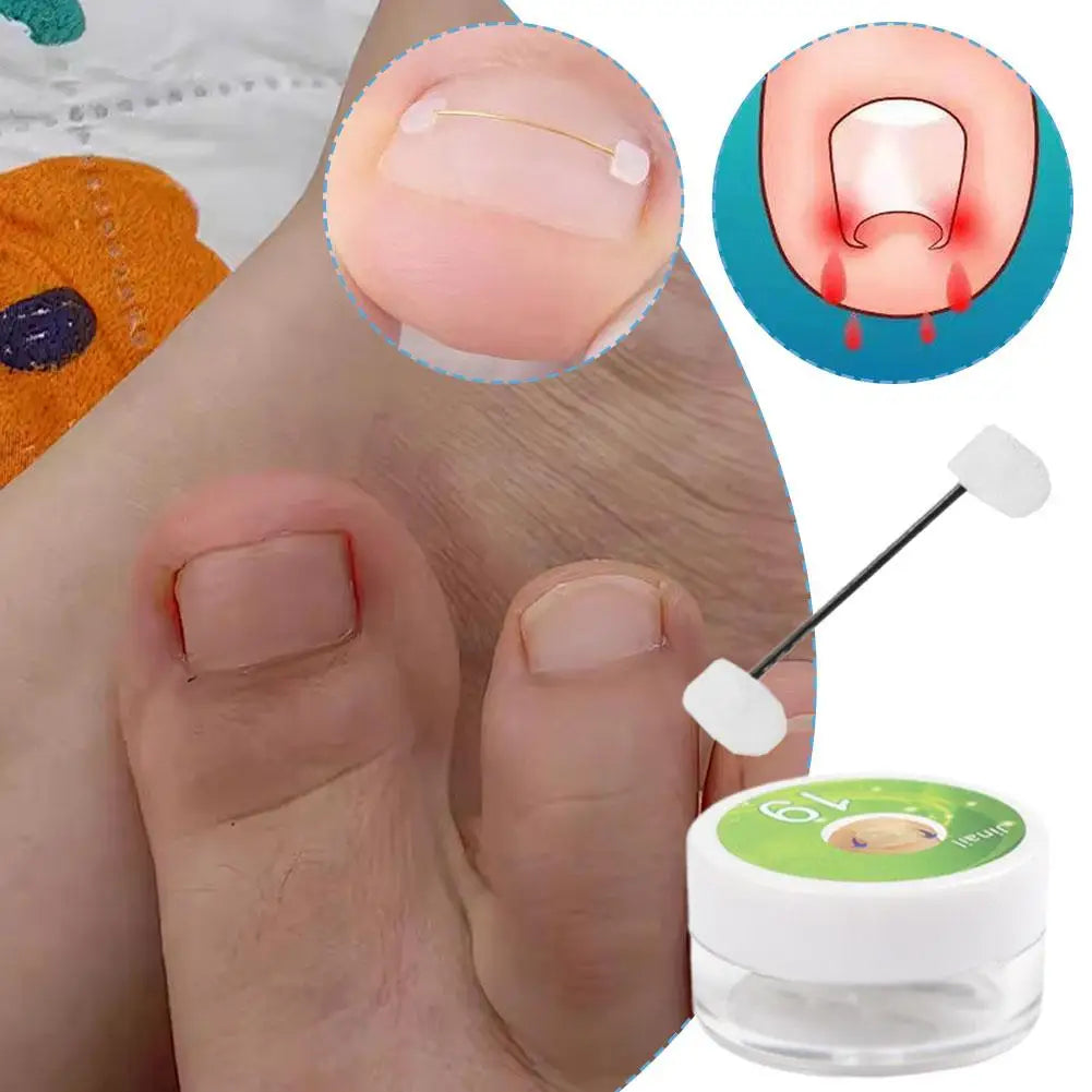 Titanium Alloy Toenail Corrector Orthopedic Sticker Memory Wire For Ingrown Nail Treatment Hallux Valgus Care Kit Ingrown Nail