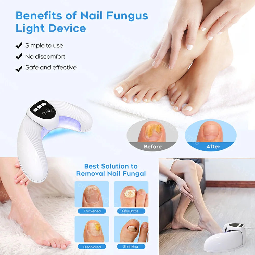 Nail Fungal Light Device Fungal Discolored Remover Portable Nail Fungal Eradication Device for Thick Toenails and Fingernails
