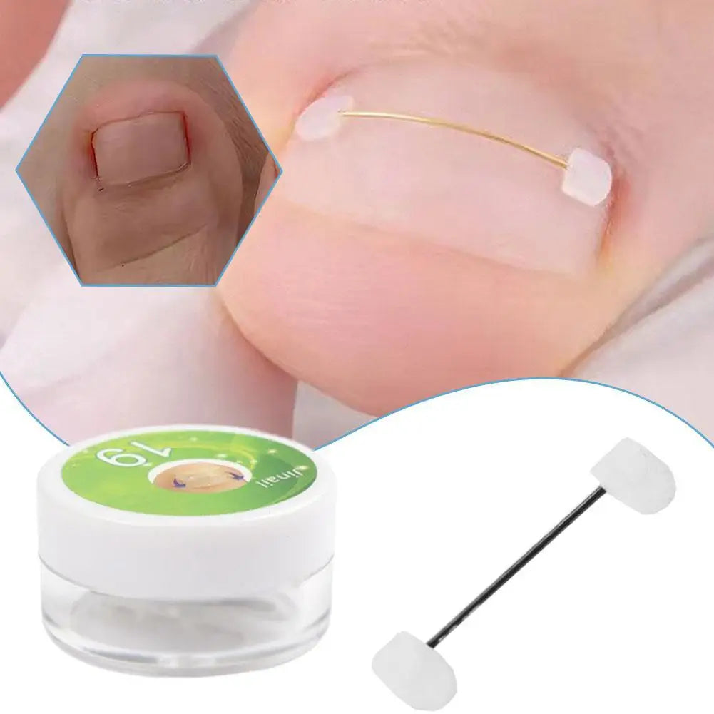 Titanium Alloy Toenail Corrector Orthopedic Sticker Memory Wire For Ingrown Nail Treatment Hallux Valgus Care Kit Ingrown Nail